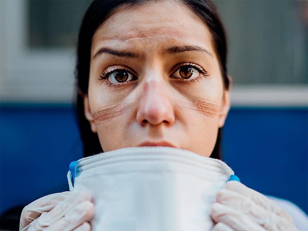Una enfermera muestra las marcas de la mascarilla en su rostro en plena crisis del COVID 19